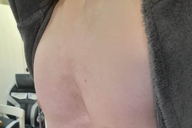 How Jacob's chest looked before the operation.