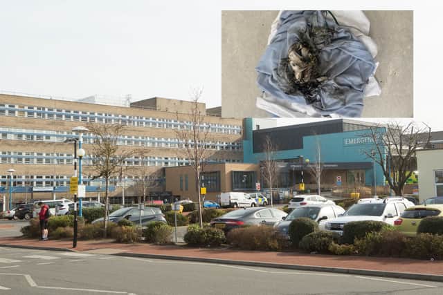 The fire is reported to have taken place at Sunderland Royal Hospital. Inset - the fire damage to a bed blanket.