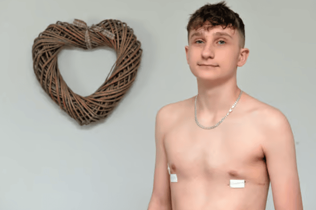 Jacob after the operation to put a metal bar put in his chest to protect his organs.