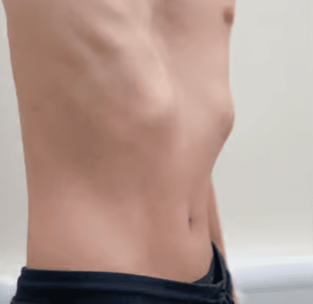 Jacob's chest as it looked before he had the surgery which changed his life.