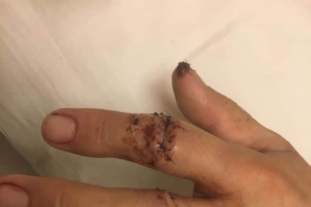 Jonathan's hand and tendons needed stitches