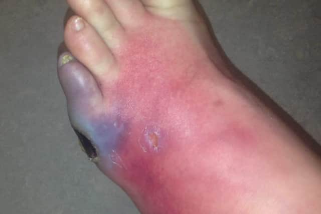 Will Ferry's swollen foot before it was amputated.