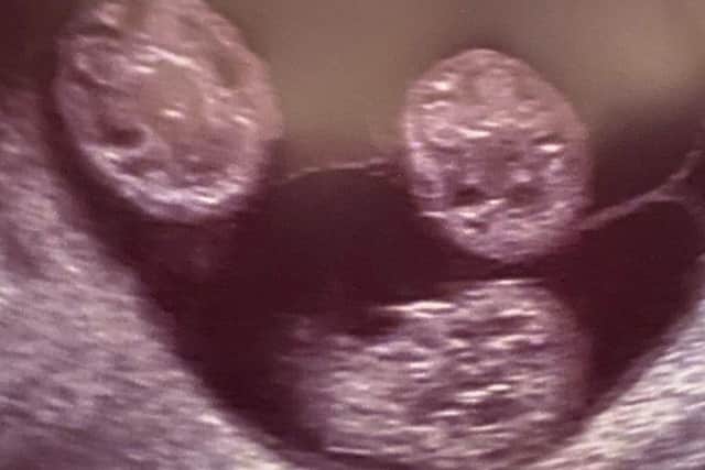 The first scan indicating the presence of triplets.