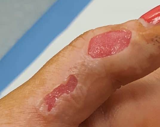 Hannah Armstrong has shared images of her serious burns in a bid to warn others about the dangers of fire.