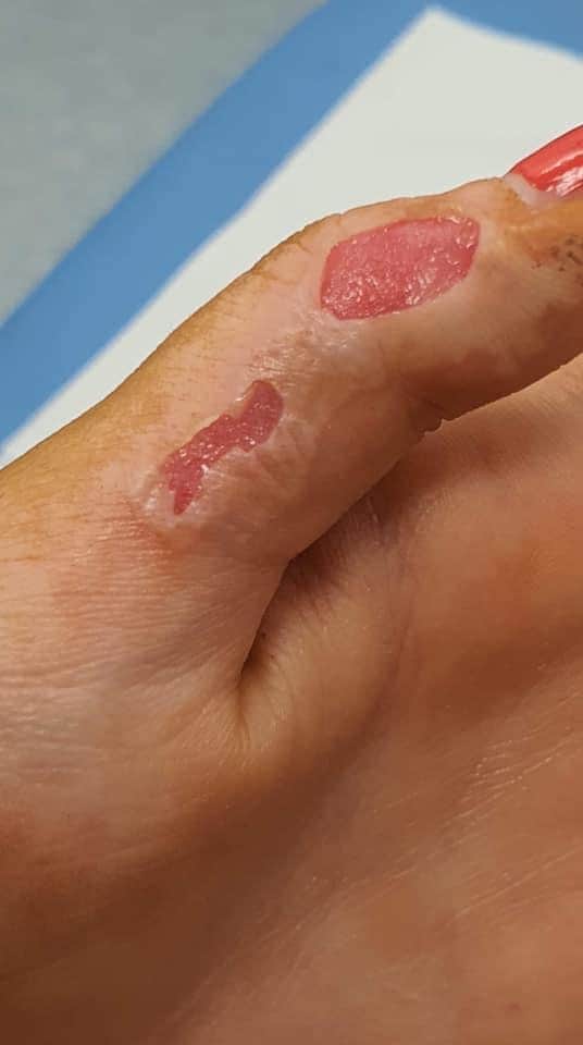 Hannah Armstrong has shared images of her serious burns in a bid to warn others about the dangers of fire.