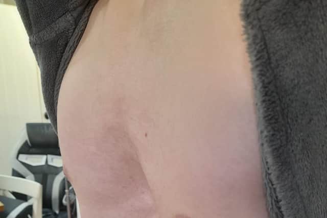 How Jacob's chest looked before the operation.