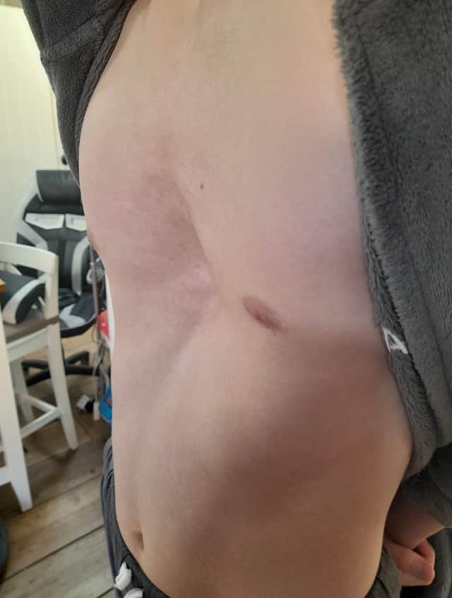 How Jacob's chest looked before the operation.