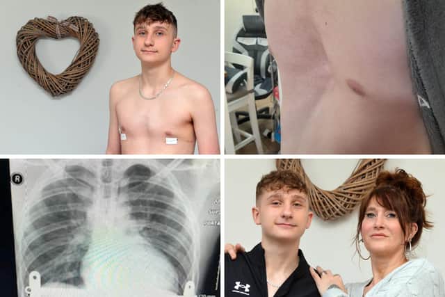 Jacob Brown whose live has been transformed after an operation.