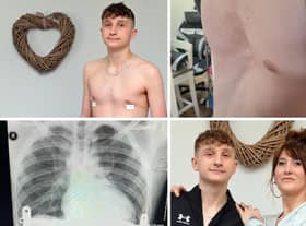 Jacob Brown whose live has been transformed after an operation.