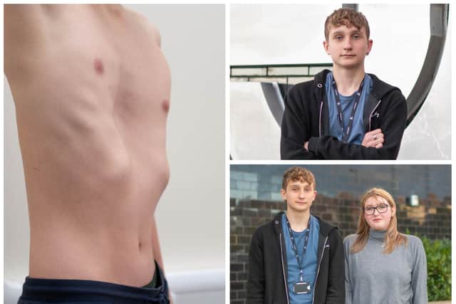 Jacob Brown, 14, who needs a life-changing operation, and with his sister Hollie.