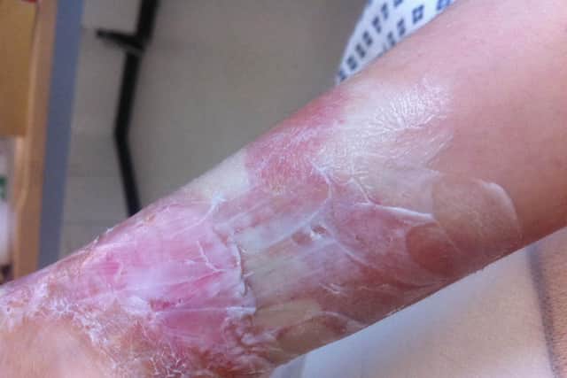 Charlotte's skin is still recovering after her blisters were cut at the hospital.