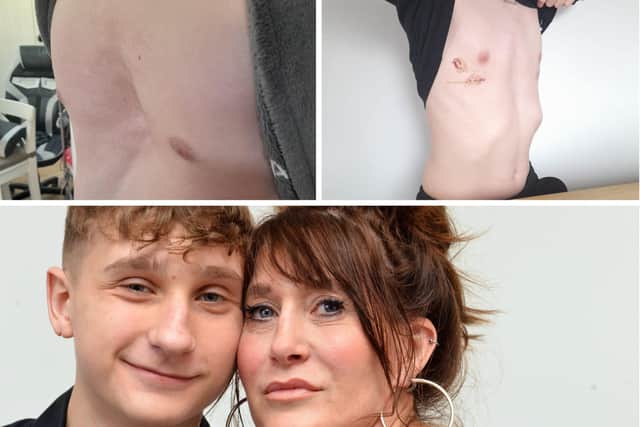 Jacob Brown and his mum Rachel, and what a transformation since he had an operation a month ago.