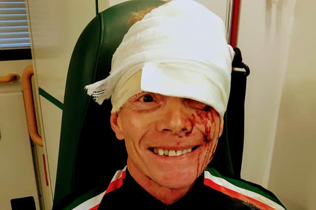 Allan Card after his accident.