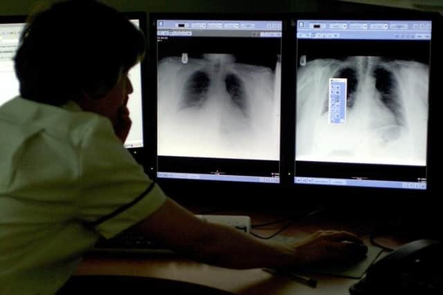 Ten TB cases a year are being recorded in Sunderland