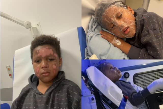 Zak's mum Jodi is calling on others to take safety precautions after her son suffered severe burns on Bonfire Night.