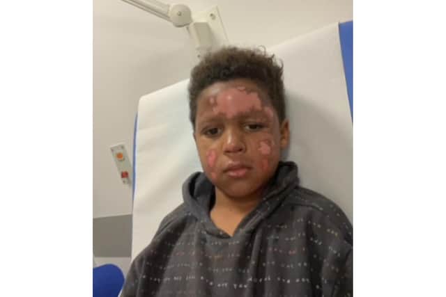 Doctors have told Zak that it will take some time for his burns to heal.