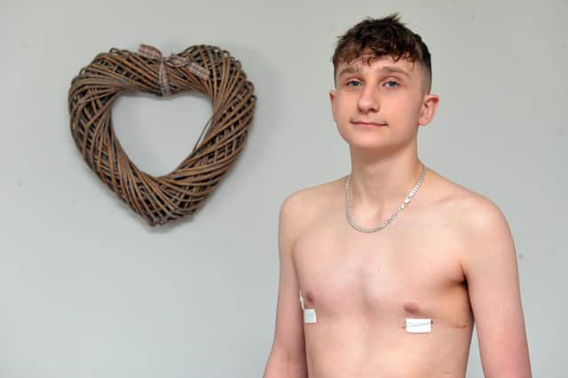 Jacob after the operation to put a metal bar put in his chest to protect his organs.