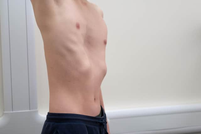 Jacob has shared this photo of his chest to raise awareness of his condition.