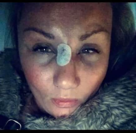 Injuries to Lauren Beattie face following an assault