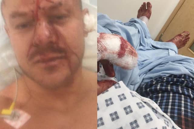 Images from the Facebook page of Jonathan Hair of himself, showing injuries he sustained from masked raiders who attacked him with a hammer and a machete in his own home. Jonathan Hair/Facebook/PA Wire.