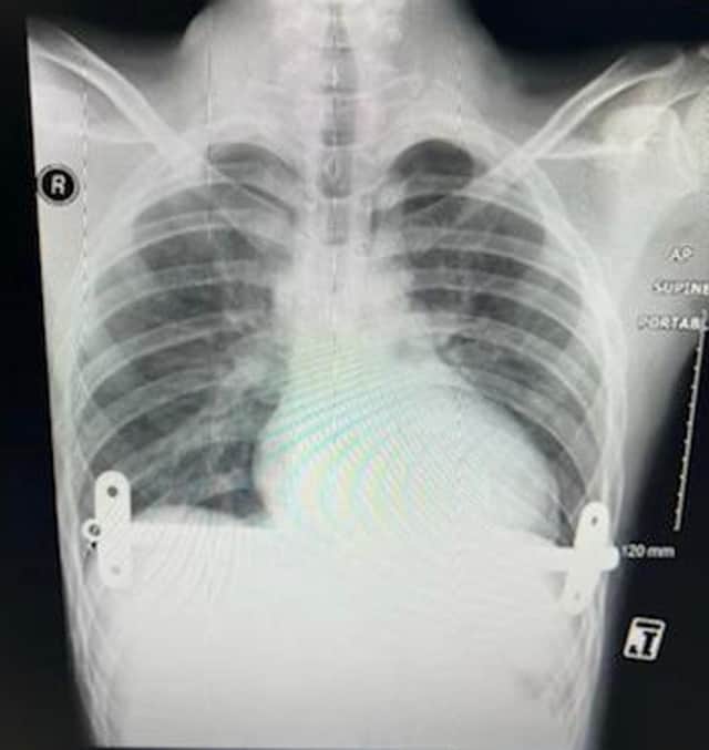 Jacob's X-ray after the metal bars were inserted.