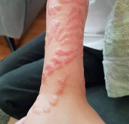The burns left on Kane Archibald after he got a black henna tattoo.