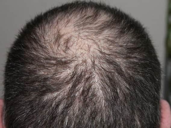 Hair loss is more common than you think.