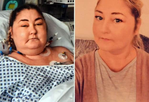 Becky Timby before and after her heart transplant surgery.