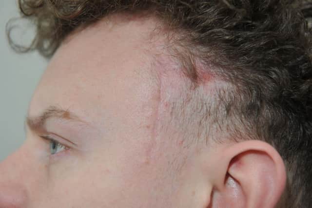 Cameron Quigley's scars following his hour-long operation.