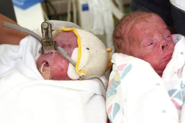 Twins Jack (left) and Thomas Ferry shortly after they were born 16 weeks prematurely.