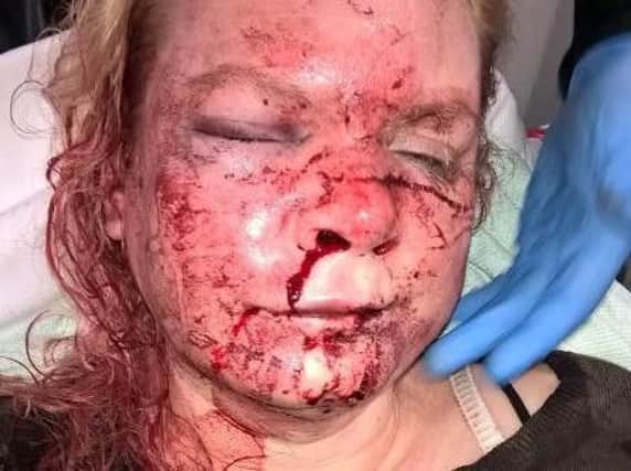 Picture of the victim's injuries, released by Northumbria Police