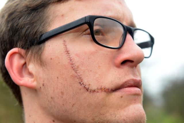 Slashing attack victim Liam Newby