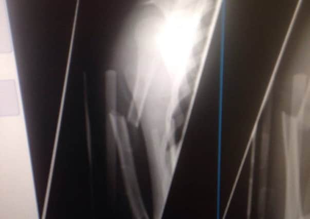 An X-ray taken of Mckenzie Williamsons broken arm.