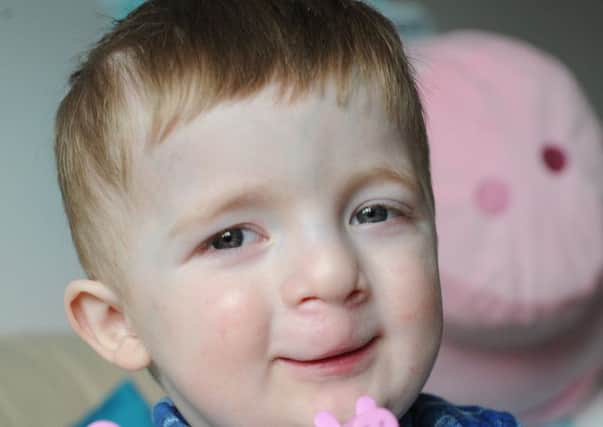 William Stothard who was born with a bilateral cleft lip and palate.