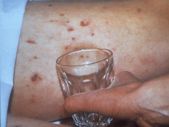 The glass test is a good way to test for meningitis. Roll a tumbler over the skin, and if the rash doesn't fade, seek urgent medical help.