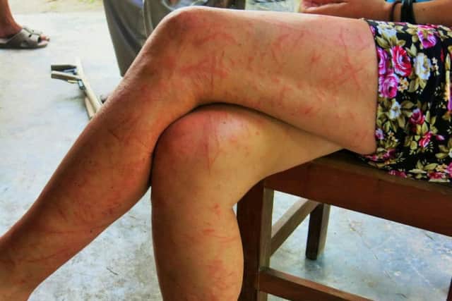 The badly scratched legs of Briton Rachel Bradley after she and her companions spent five days stranded in the jungle after taking a wrong turn on a boat trip. Pic: Ninth Wave Global.