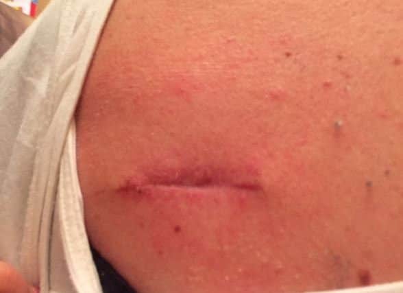 The scar left on Kerry Rafferty's back after the removal of a cancerous mole.