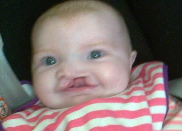 Millie Fountain, pictured before she underwent the procedure to repair her lip.