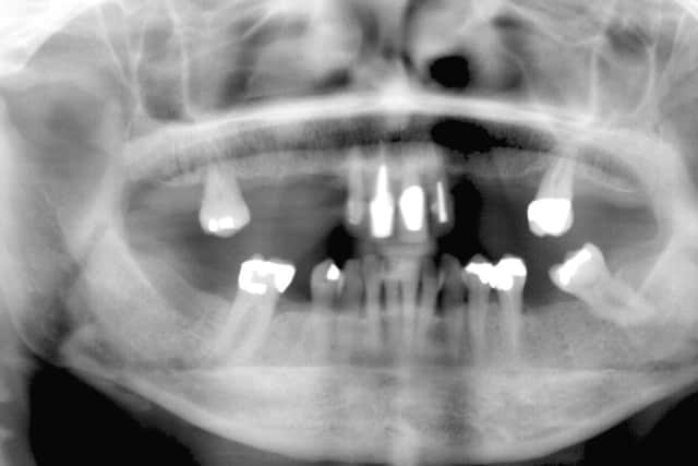 An X-ray of Judith Mcardle's teeth showing the missing upper teeth and bone loss around the remainder due to gum disease.