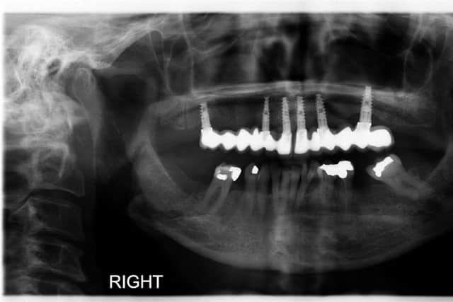 An X-ray of Judith Mcardle's teeth showing all upper teeth removed and replaced with six implants and two bridges.