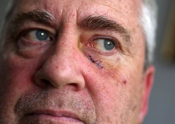 Andrew Emmerson, of Seaham, says he was attacked by a hawk while on a cycle path with his grandson on Monday. He has had to have stitches on his face and is warning others about birds being in the area.  Picture by Tom Banks