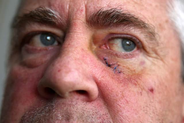 Andrew Emmerson, of Seaham, says he was attacked by a hawk while on a cycle path with his grandson on Monday. He has had to have stitches on his face and is warning others about birds being in the area.  Picture by Tom Banks